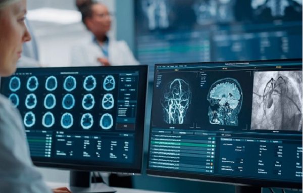 Inteligencia Artificial revoluciona la detección temprana de accidentes cerebrovasculares